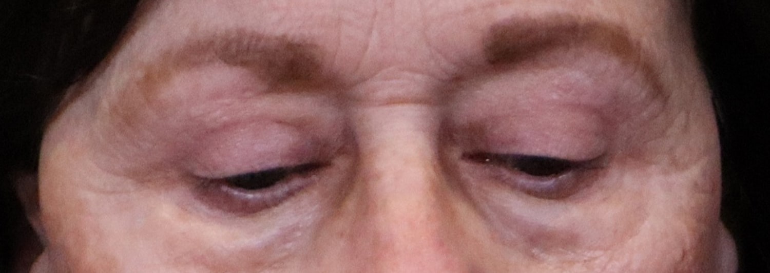 After Image: Blepharoplasty - front