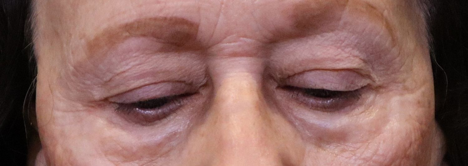 Before Image: Blepharoplasty - front