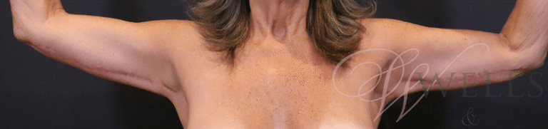 After Image: Brachioplasty - front