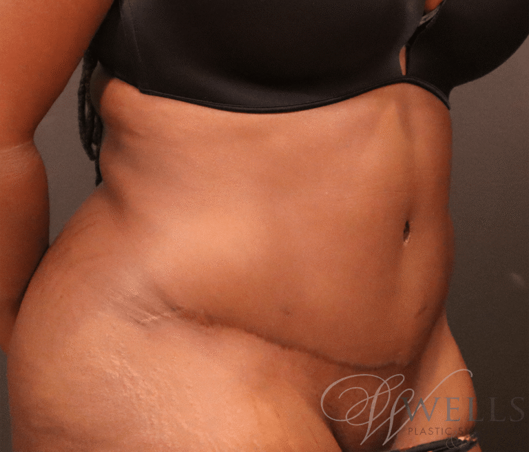 After Image: Abdominoplasty - right-front-oblique