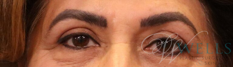 After Image: Blepharoplasty - front