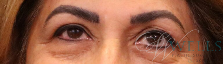 Before Image: Blepharoplasty - front