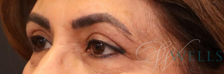 After Image: Blepharoplasty - left-front-oblique