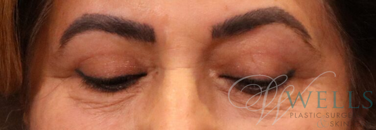 After Image: Blepharoplasty - front