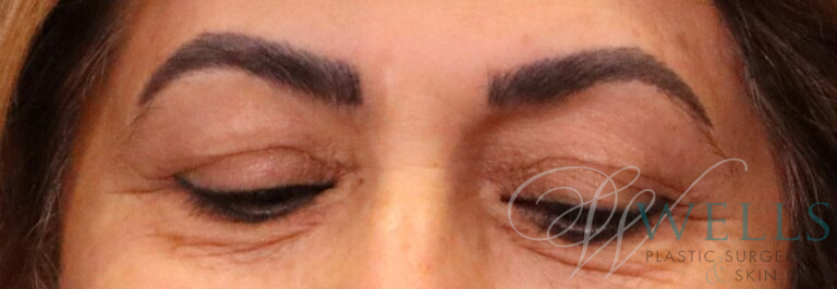 Before Image: Blepharoplasty - front