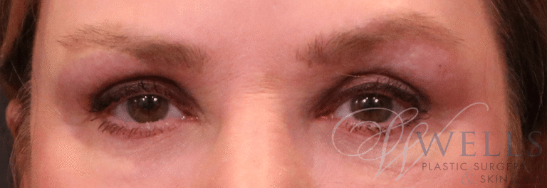 After Image: Blepharoplasty - front