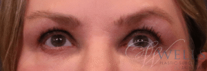 Before Image: Blepharoplasty