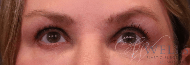 Before Image: Blepharoplasty - front