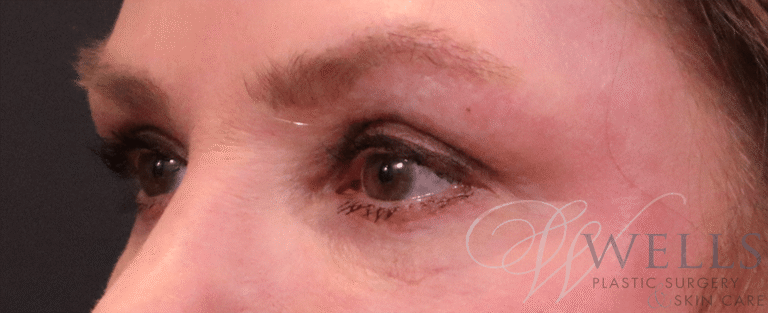 After Image: Blepharoplasty - left-front-oblique