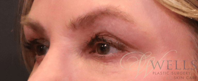 Before Image: Blepharoplasty - left-front-oblique