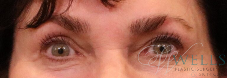 After Image: Blepharoplasty - front