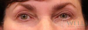 Before Image: Blepharoplasty