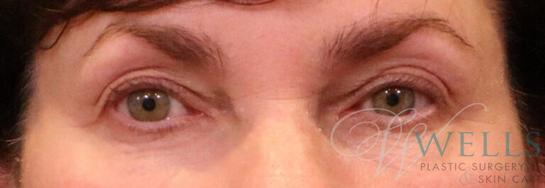 Before Image: Blepharoplasty - front