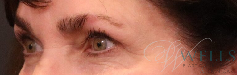 After Image: Blepharoplasty - left-front-oblique