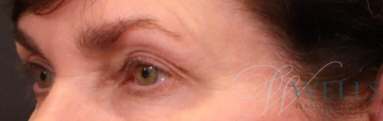 Before Image: Blepharoplasty - left-front-oblique