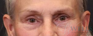 After Image: Blepharoplasty