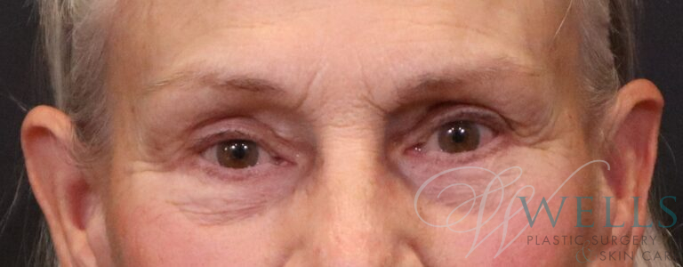 After Image: Blepharoplasty - front