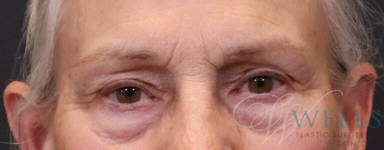 Before Image: Blepharoplasty - front