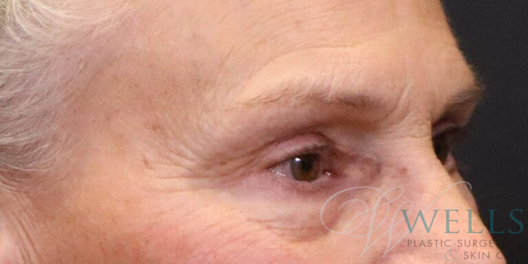 After Image: Blepharoplasty - right-front-oblique
