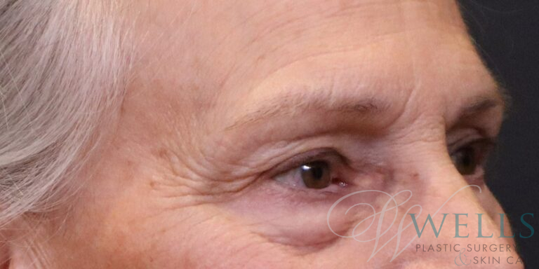 Before Image: Blepharoplasty - right-front-oblique