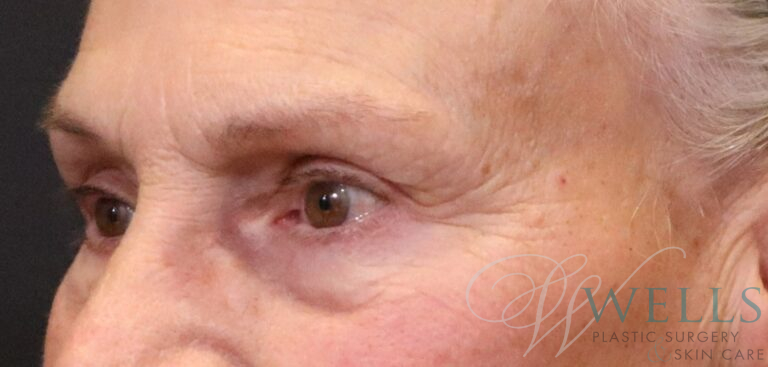 After Image: Blepharoplasty - left-front-oblique