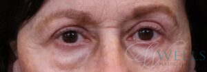 After Image: Blepharoplasty