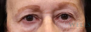 Before Image: Blepharoplasty