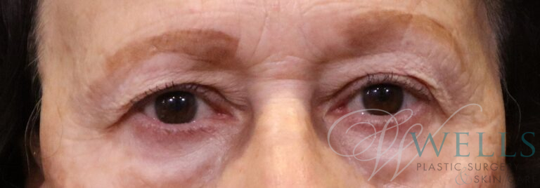 Before Image: Blepharoplasty - front