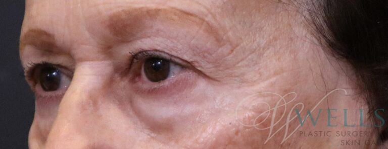 Before Image: Blepharoplasty - left-front-oblique