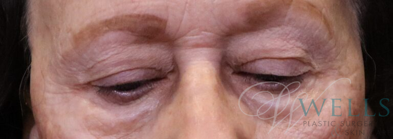 Before Image: Blepharoplasty - front