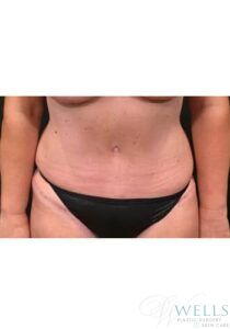 After Image: Abdominoplasty