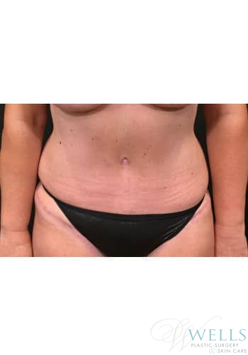 After Image: Abdominoplasty - front