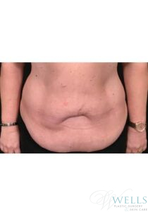 Before Image: Abdominoplasty