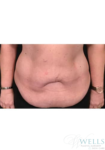 Before Image: Abdominoplasty - front