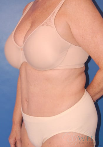 After Image: Abdominoplasty - left-front-oblique