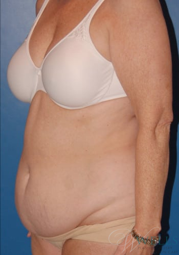 Before Image: Abdominoplasty - left-front-oblique