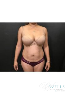 Before Image: Abdominoplasty