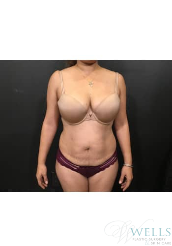 Before Image: Abdominoplasty - front