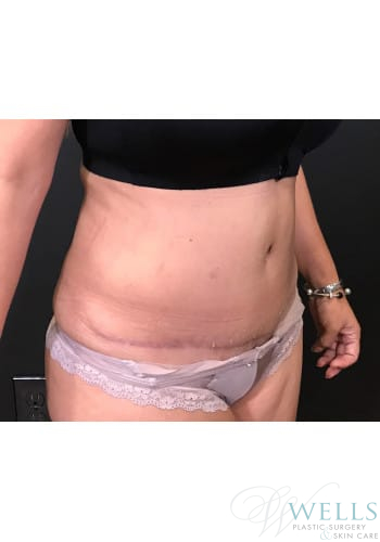 After Image: Abdominoplasty - right-front-oblique