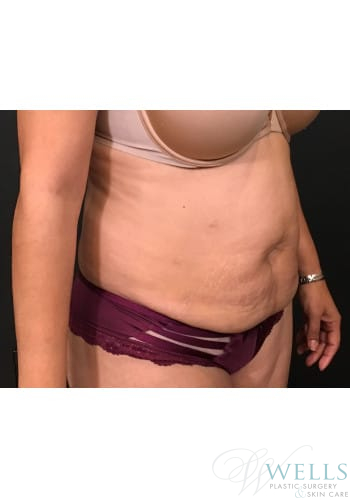 Before Image: Abdominoplasty - right-front-oblique