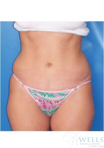 After Image: Abdominoplasty