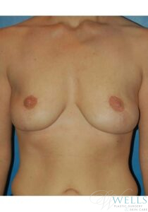 After Image: Breast Lift