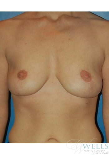 After Image: Breast Lift - front