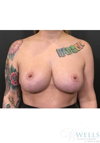 After Image: Breast Reduction - front