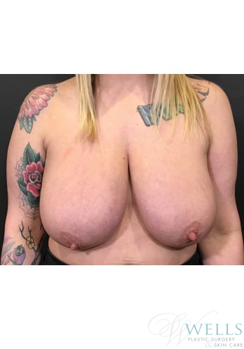 Before Image: Breast Reduction - front
