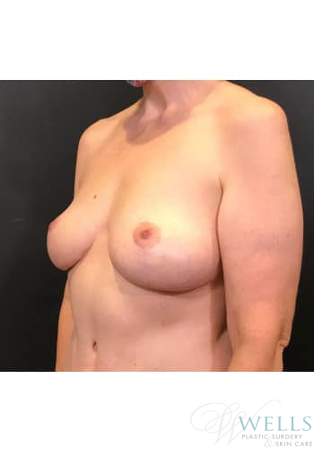 After Image: Breast Reduction - left-front-oblique