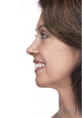 After Image: Comprehensive Makeovers - left-side