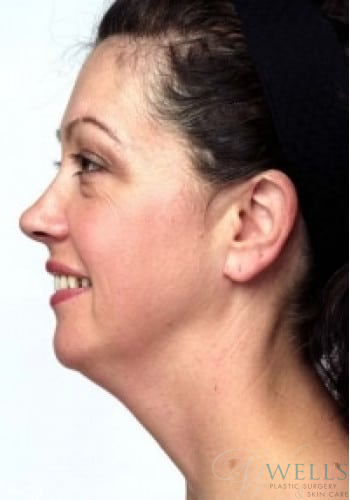 Before Image: Comprehensive Makeovers - left-side
