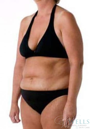 Before Image: Comprehensive Makeovers - left-front-oblique