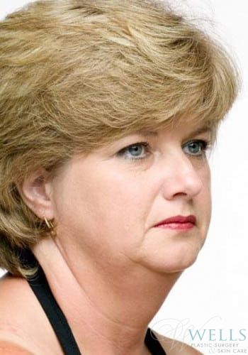 Before Image: Comprehensive Makeovers - right-front-oblique